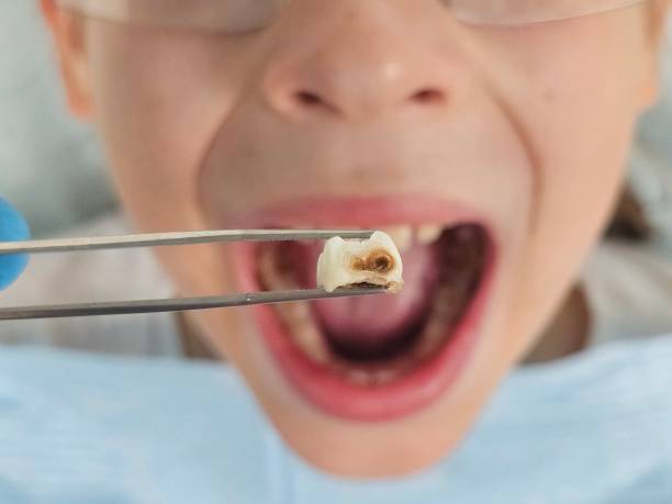 Best Emergency Dentist for Lost Fillings or Crowns in Clear Lake, WA