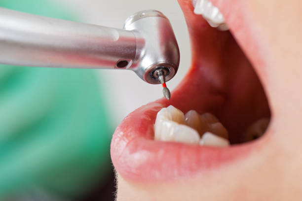 Best Emergency Root Canal Treatment in Clear Lake, WA